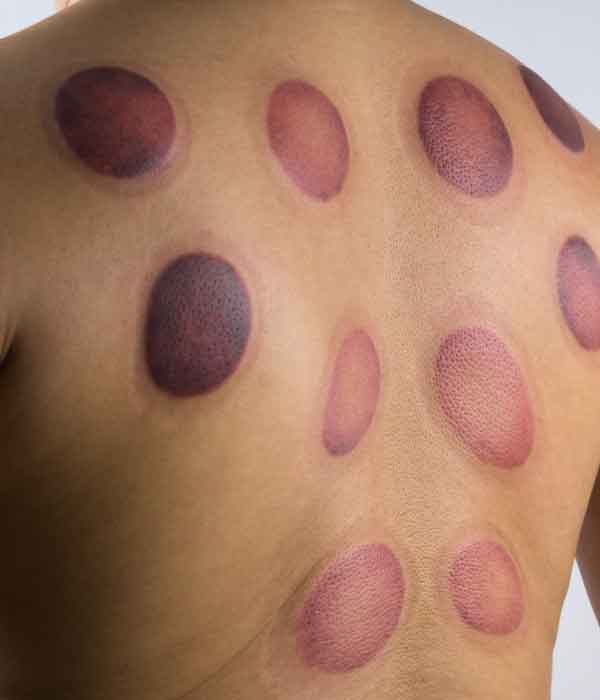 redcliffe cupping therapy newport